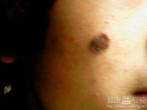 激光点痣后可以吃哈密瓜,激光点痣后适宜食用的水果——哈密瓜的益处